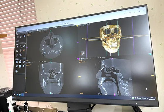 歯科用CT 3D撮影