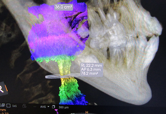 歯科用CT 気道解析機能